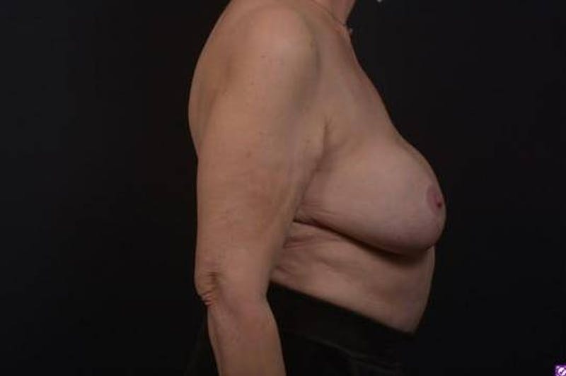 Aesthetic Breast Revision Before & After Gallery - Patient 146385 - Image 9