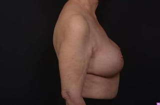 Aesthetic Breast Revision Before & After Gallery - Patient 146385 - Image 10