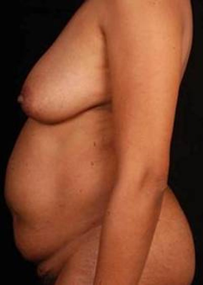 Abdominoplasty Before & After Gallery - Patient 965630 - Image 3