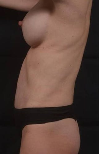 Mommy Makeover Before & After Gallery - Patient 225142 - Image 6