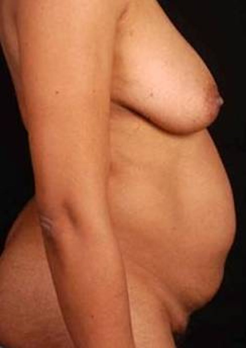 Abdominoplasty Before & After Gallery - Patient 965630 - Image 5