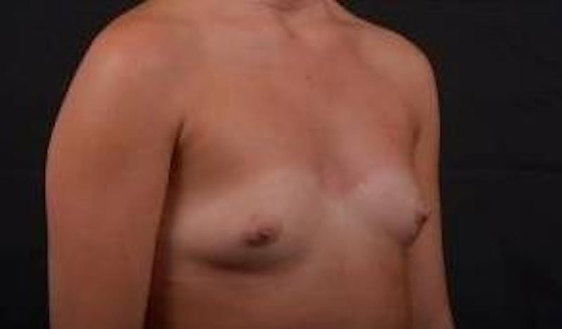 Breast Augmentation Silicone Gel Before & After Gallery - Patient 204200 - Image 9