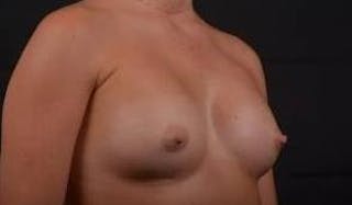 Breast Augmentation Silicone Gel Before & After Gallery - Patient 204200 - Image 10