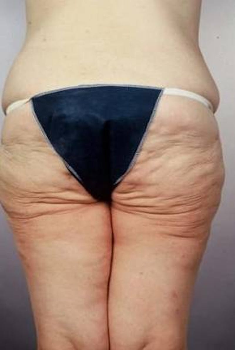 Abdominoplasty Before & After Gallery - Patient 124788 - Image 3