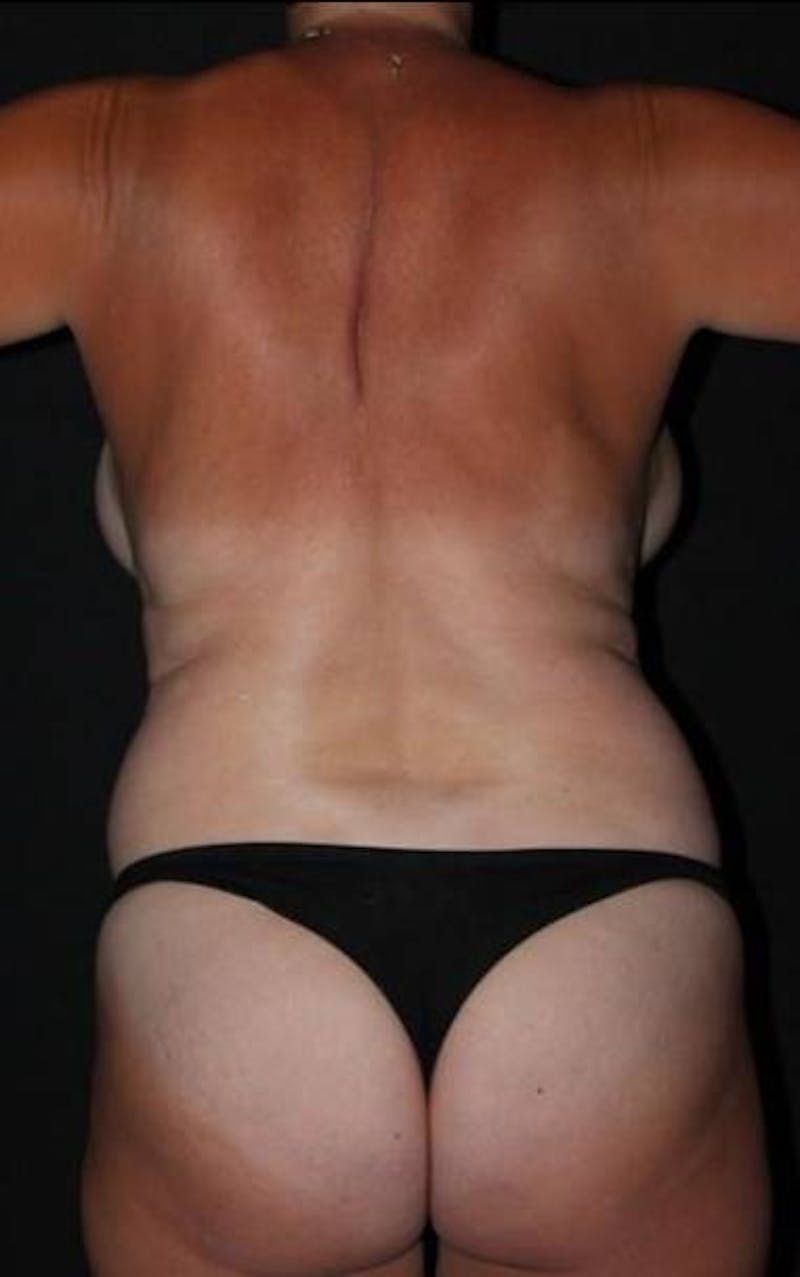 Mommy Makeover Before & After Gallery - Patient 414818 - Image 11