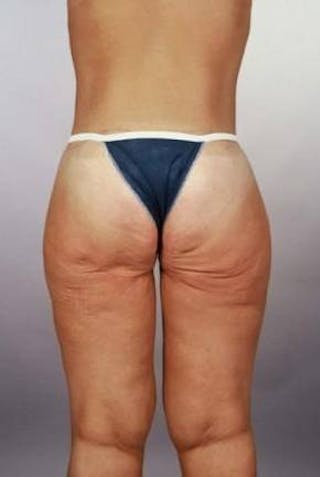 Abdominoplasty Before & After Gallery - Patient 124788 - Image 4