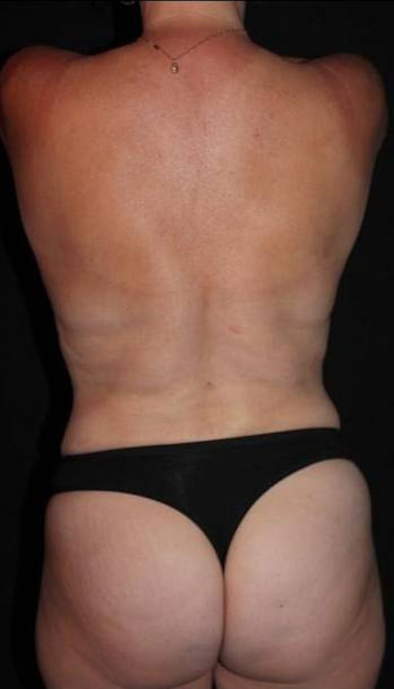 Mommy Makeover Before & After Gallery - Patient 414818 - Image 12