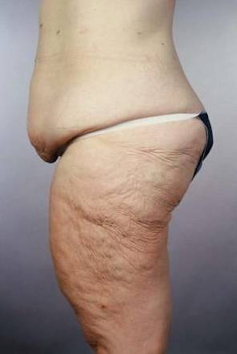 Abdominoplasty Before & After Gallery - Patient 124788 - Image 5