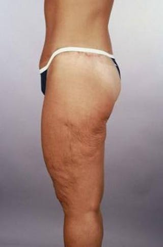 Abdominoplasty Before & After Gallery - Patient 124788 - Image 6