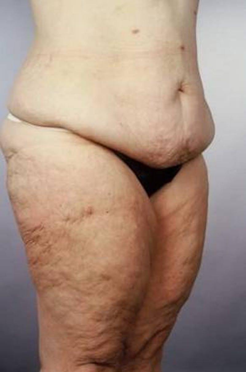 Abdominoplasty Before & After Gallery - Patient 124788 - Image 7