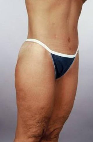 Abdominoplasty Before & After Gallery - Patient 124788 - Image 8