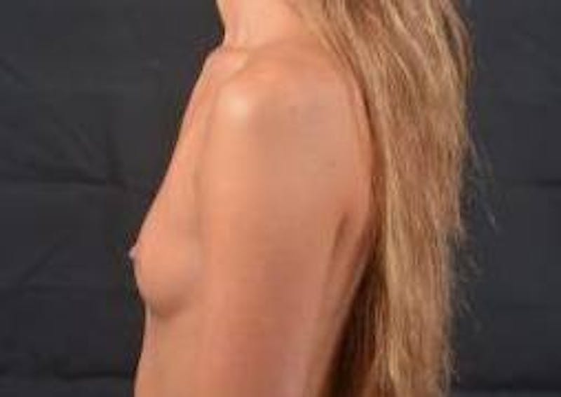 Breast Augmentation Silicone Gel Before & After Gallery - Patient 257979 - Image 3