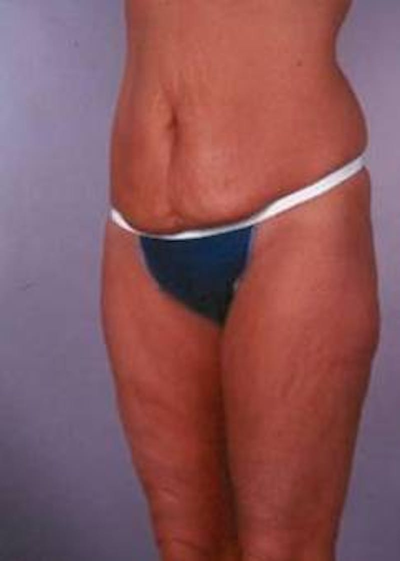 Abdominoplasty Before & After Gallery - Patient 380290 - Image 3