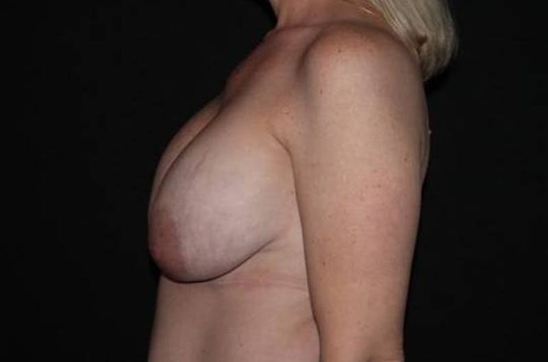 Aesthetic Breast Revision Before & After Gallery - Patient 279885 - Image 5