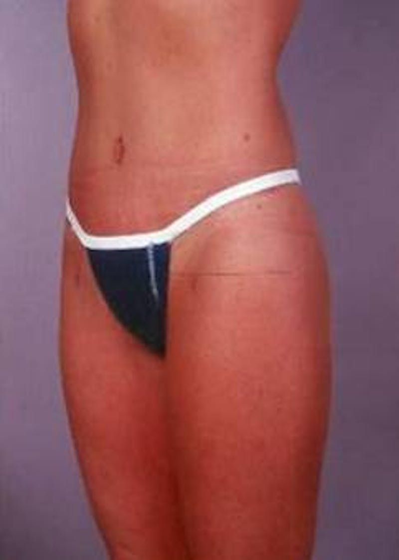 Abdominoplasty Before & After Gallery - Patient 380290 - Image 4