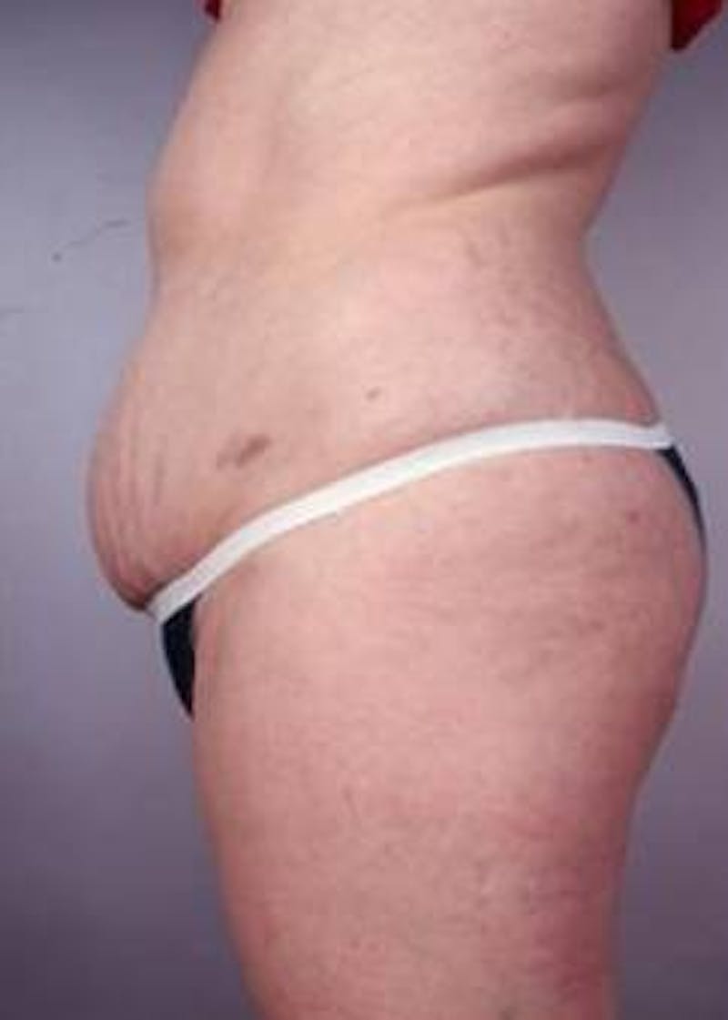 Abdominoplasty Before & After Gallery - Patient 196193 - Image 3