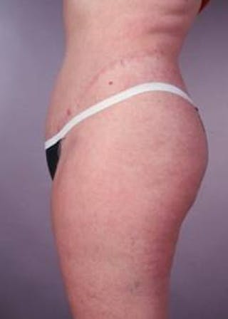 Abdominoplasty Before & After Gallery - Patient 196193 - Image 4
