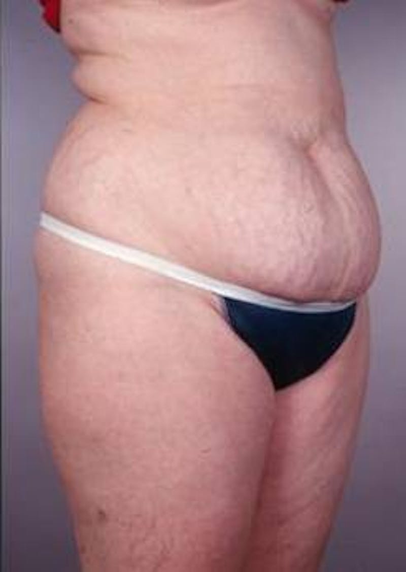 Abdominoplasty Before & After Gallery - Patient 196193 - Image 5