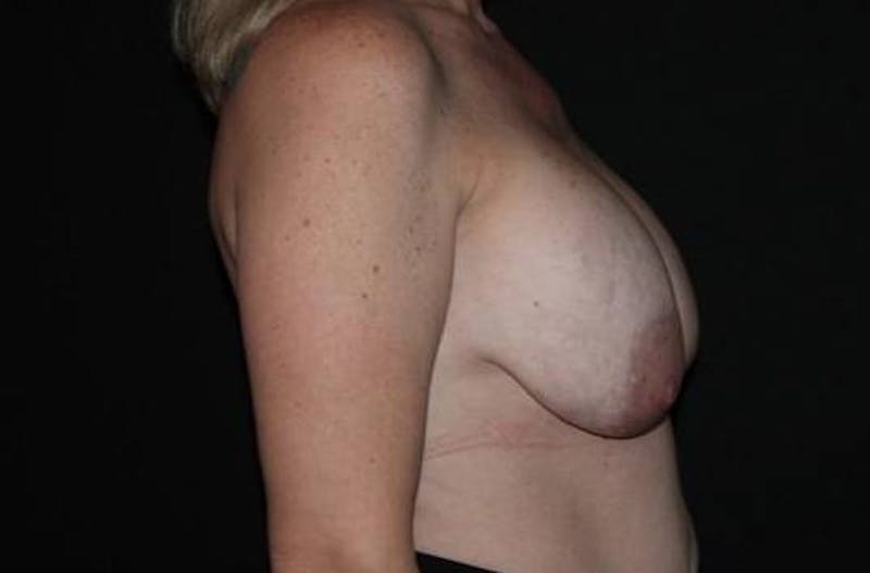 Aesthetic Breast Revision Before & After Gallery - Patient 279885 - Image 9