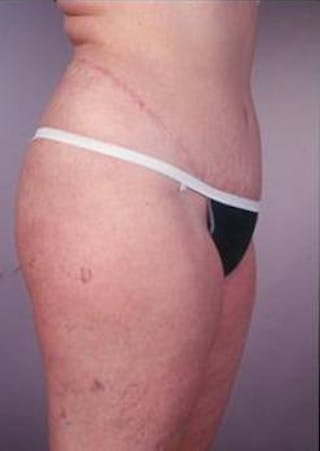 Abdominoplasty Before & After Gallery - Patient 196193 - Image 6