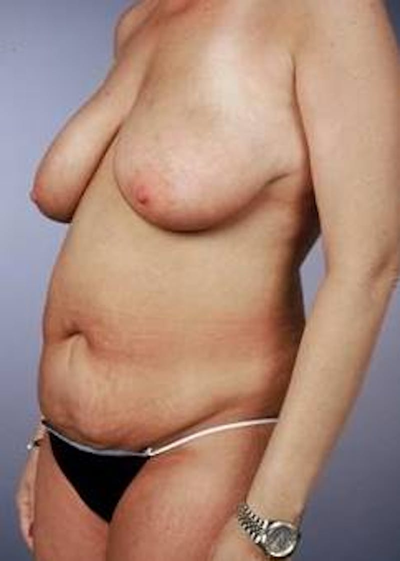 Abdominoplasty Before & After Gallery - Patient 398898 - Image 3