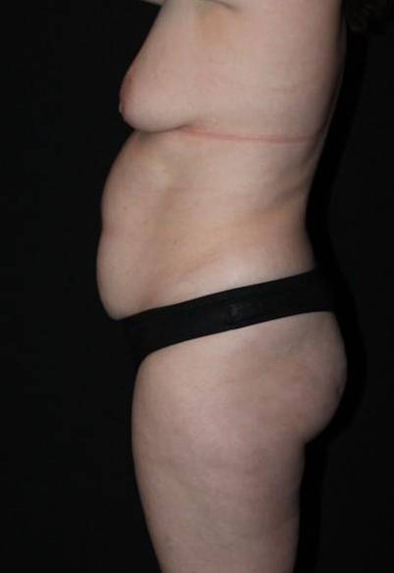 Mommy Makeover Before & After Gallery - Patient 136177 - Image 5