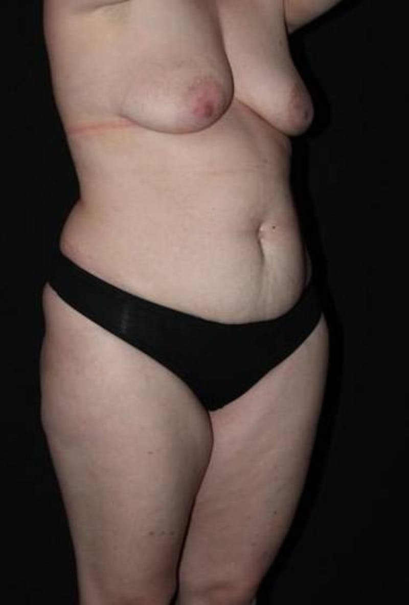 Mommy Makeover Before & After Gallery - Patient 136177 - Image 7