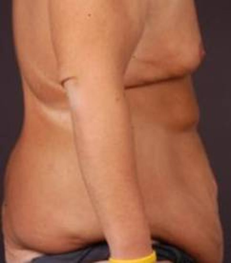 Abdominoplasty Before & After Gallery - Patient 286840 - Image 3