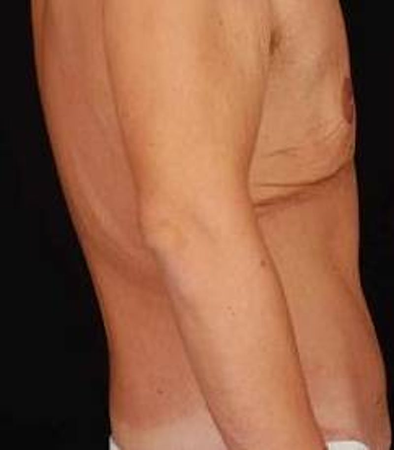 Abdominoplasty Before & After Gallery - Patient 286840 - Image 4