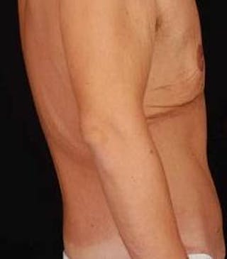 Abdominoplasty Before & After Gallery - Patient 286840 - Image 4