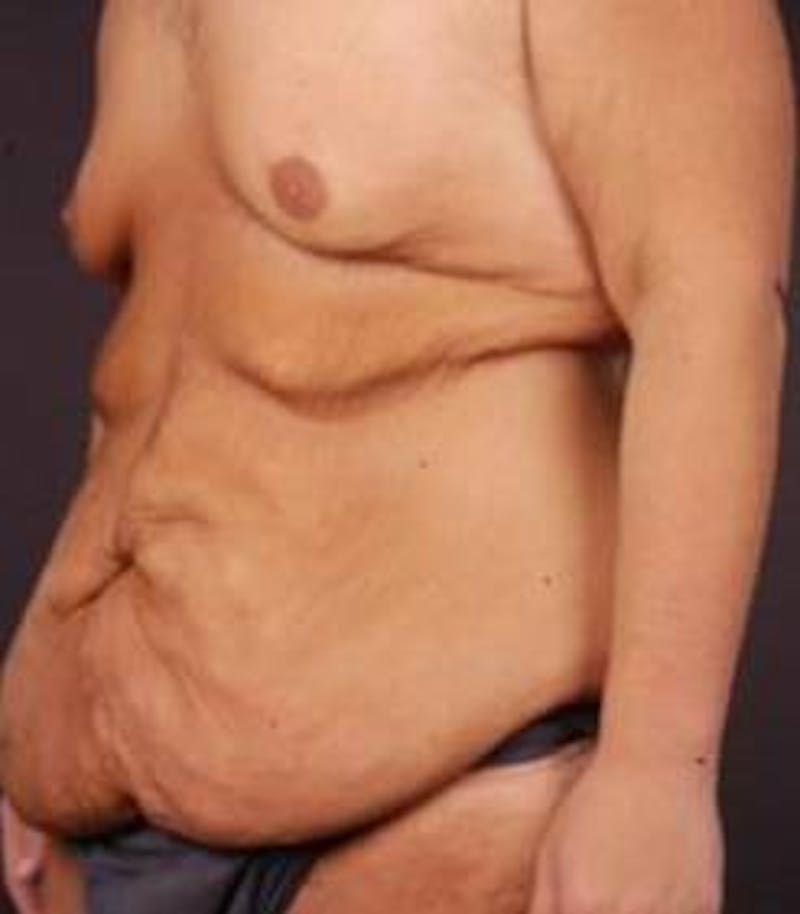 Abdominoplasty Before & After Gallery - Patient 286840 - Image 5