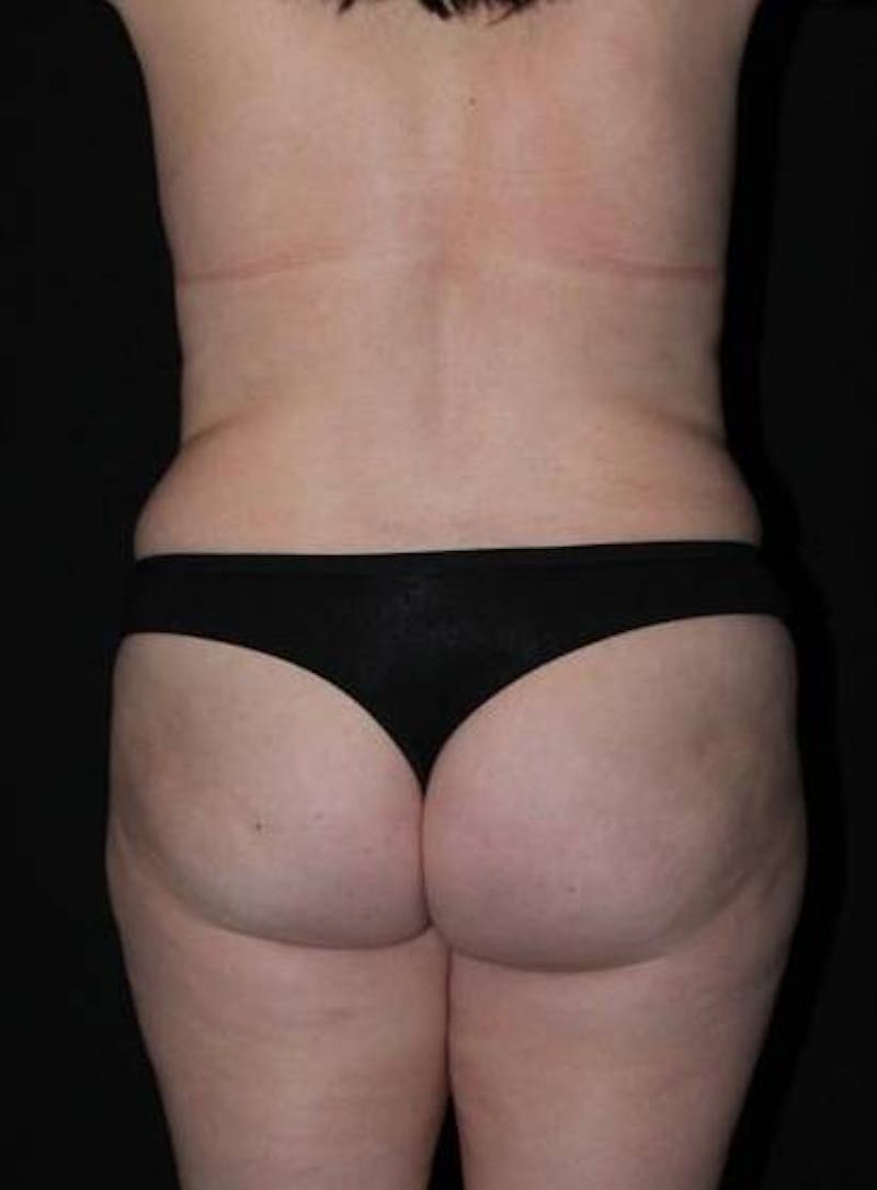 Mommy Makeover Before & After Gallery - Patient 136177 - Image 11