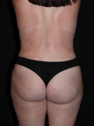 Mommy Makeover Before & After Gallery - Patient 136177 - Image 12