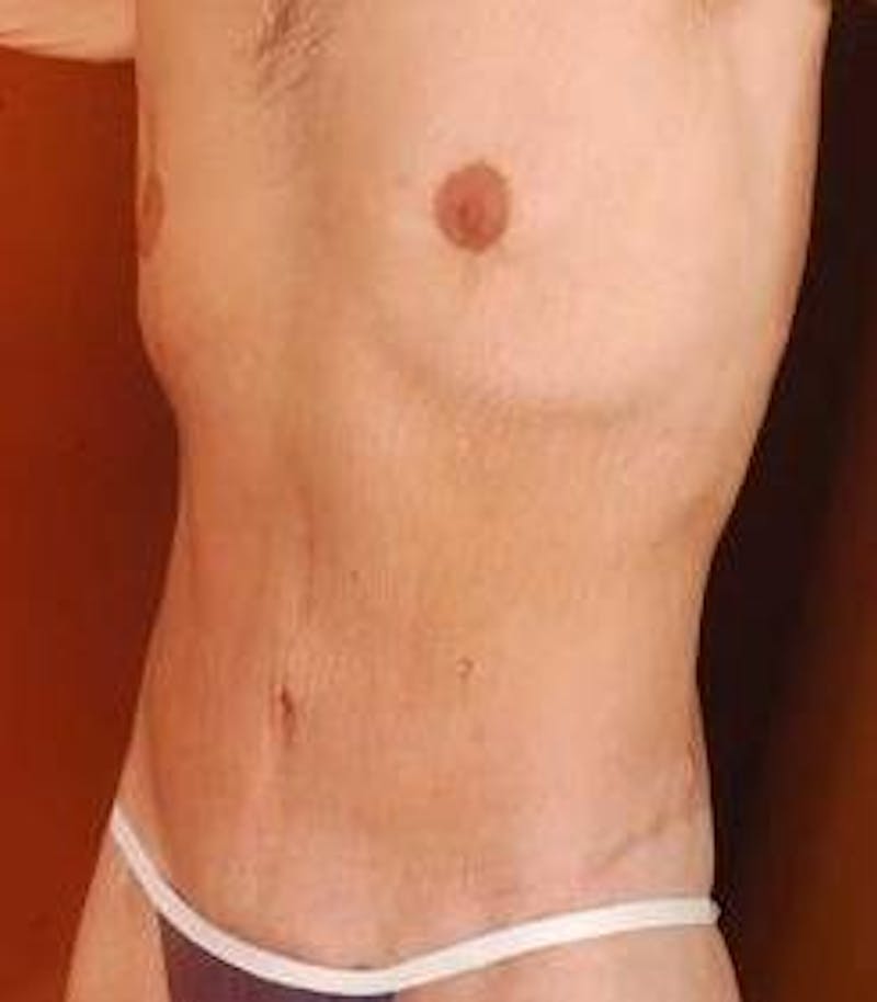 Abdominoplasty Before & After Gallery - Patient 286840 - Image 6