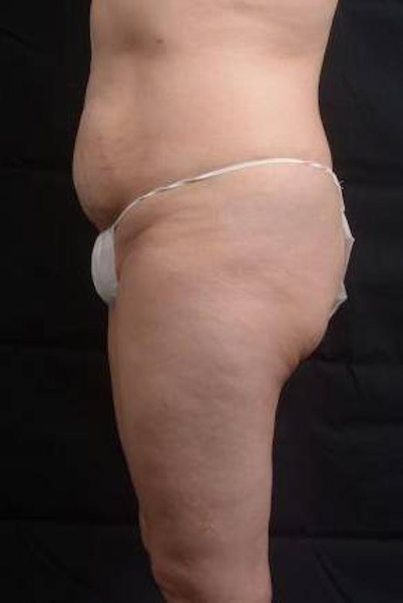 Abdominoplasty Before & After Gallery - Patient 129456 - Image 3