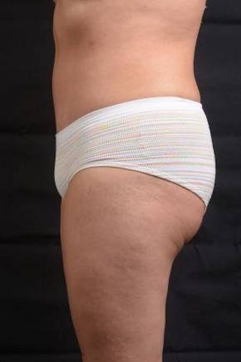 Abdominoplasty Before & After Gallery - Patient 129456 - Image 4