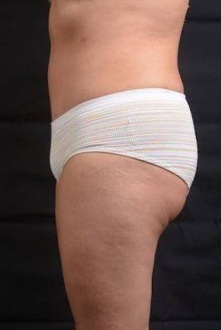 Abdominoplasty Before & After Gallery - Patient 129456 - Image 4