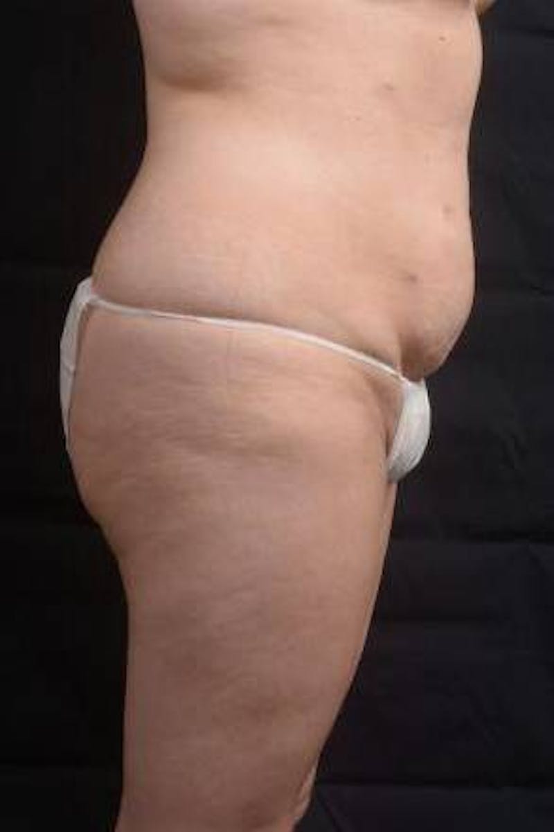 Abdominoplasty Before & After Gallery - Patient 129456 - Image 5