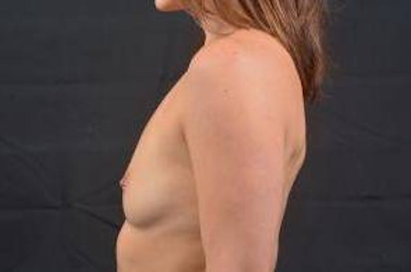 Breast Augmentation Silicone Gel Before & After Gallery - Patient 168265 - Image 3