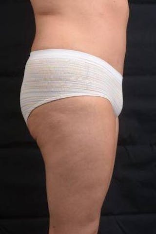 Abdominoplasty Before & After Gallery - Patient 129456 - Image 6
