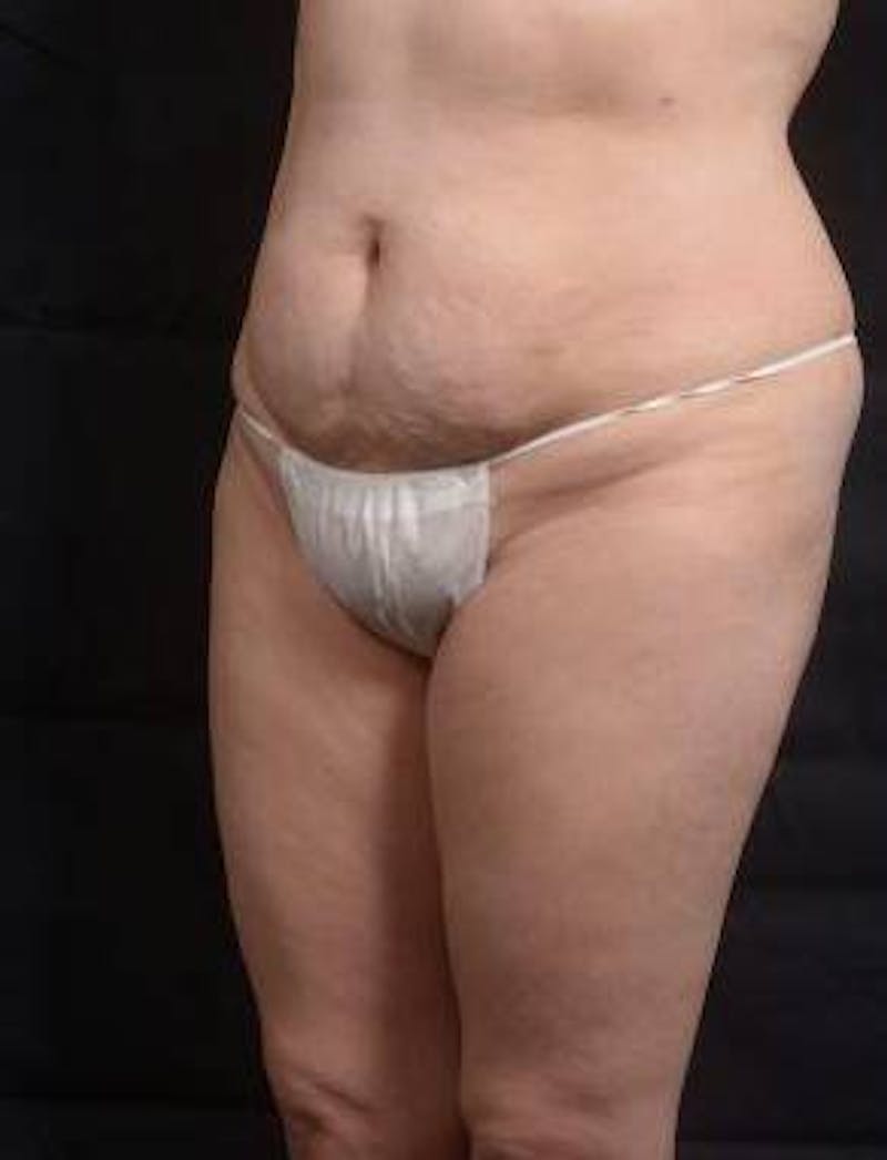 Abdominoplasty Before & After Gallery - Patient 129456 - Image 7