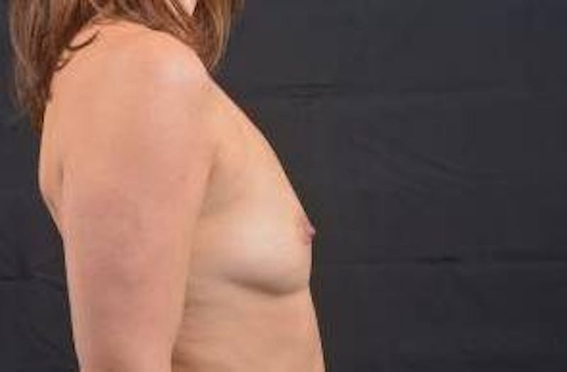 Breast Augmentation Silicone Gel Before & After Gallery - Patient 168265 - Image 5