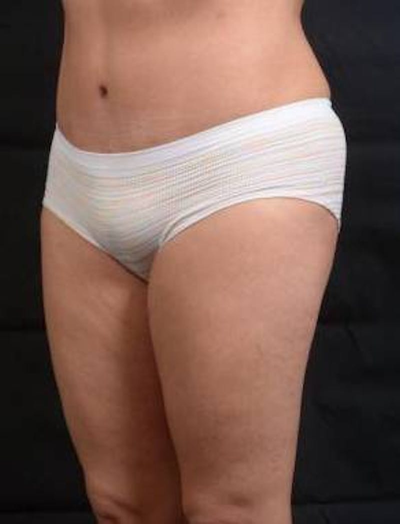 Abdominoplasty Before & After Gallery - Patient 129456 - Image 8
