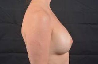 Breast Augmentation Silicone Gel Before & After Gallery - Patient 168265 - Image 6