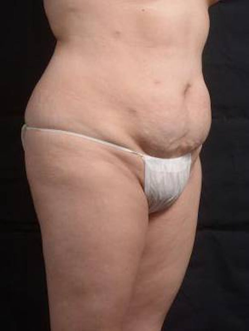 Abdominoplasty Before & After Gallery - Patient 129456 - Image 9