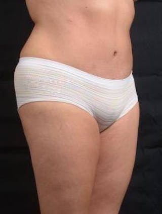 Abdominoplasty Before & After Gallery - Patient 129456 - Image 10