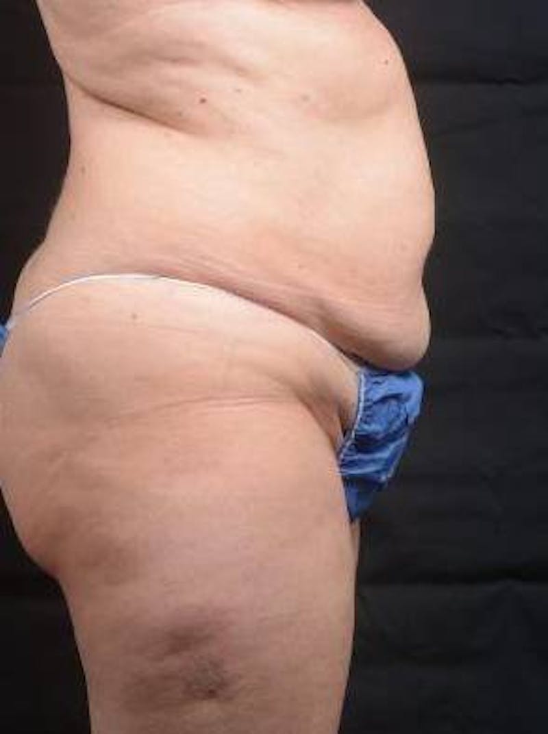 Abdominoplasty Before & After Gallery - Patient 296367 - Image 5
