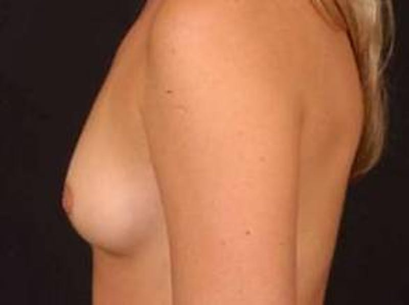 Breast Augmentation Silicone Gel Before & After Gallery - Patient 234729 - Image 3