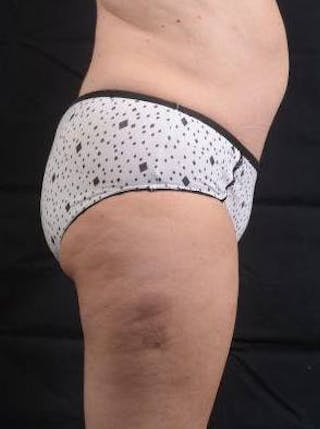 Abdominoplasty Before & After Gallery - Patient 296367 - Image 6