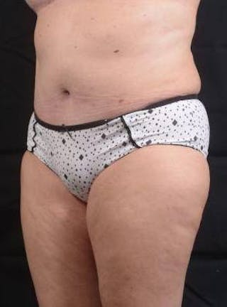 Abdominoplasty Before & After Gallery - Patient 296367 - Image 8